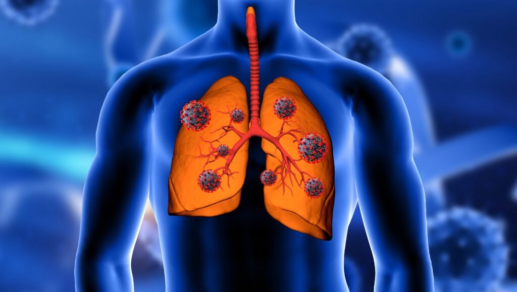 Fibrosis Quística HGW
